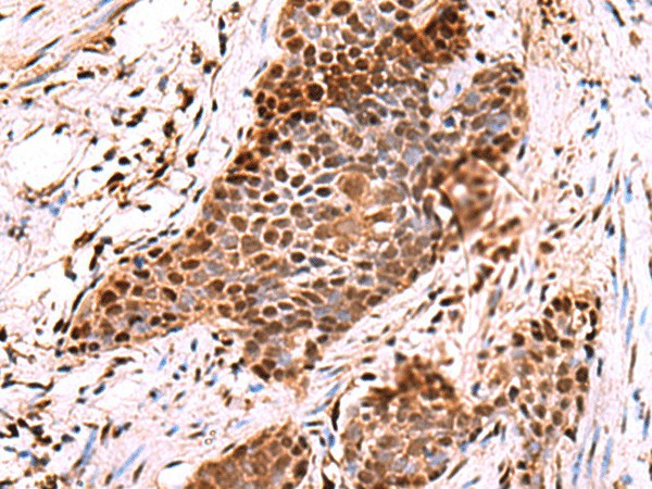 Immunohistochemistry of paraffin-embedded Human esophagus cancer tissue  using POLD2 Polyclonal Antibody at dilution of 1:60(?200)