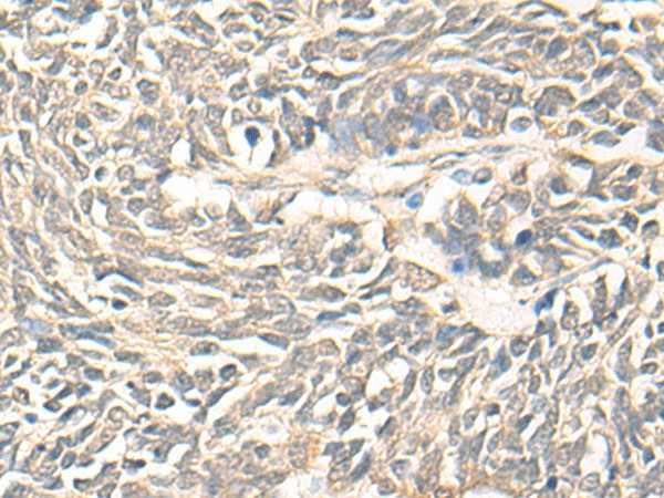 Immunohistochemistry of paraffin-embedded Human lung cancer tissue  using DMC1 Polyclonal Antibody at dilution of 1:30(?200)