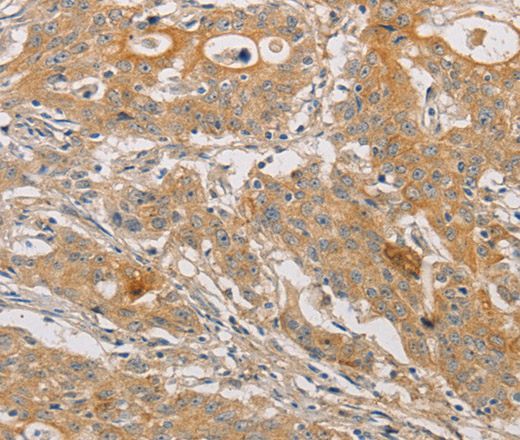 Immunohistochemistry of paraffin-embedded Human gasrtic cancer tissue using ARSK Polyclonal Antibody at dilution 1:30