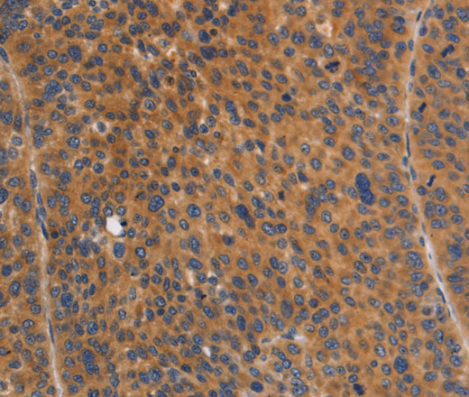 Immunohistochemistry of paraffin-embedded Human liver cancer tissue using NOD1 Polyclonal Antibody at dilution 1:50