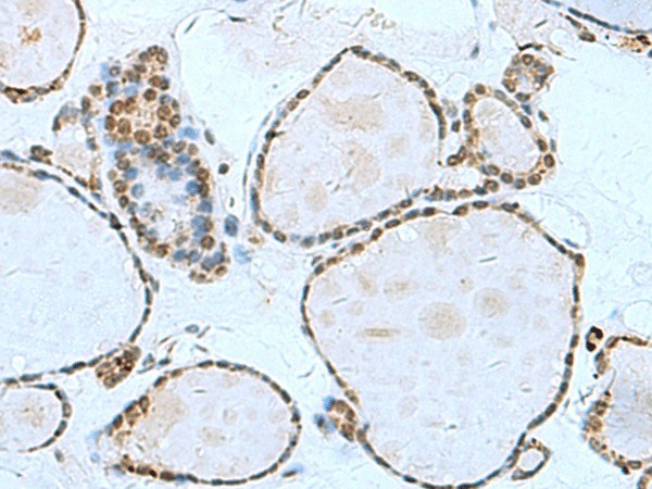 Immunohistochemistry of paraffin-embedded Human thyroid cancer tissue  using L3MBTL2 Polyclonal Antibody at dilution of 1:70(?200)