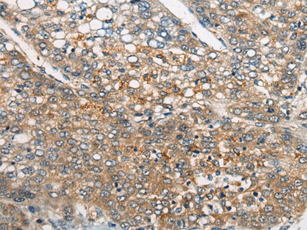 Immunohistochemistry of paraffin-embedded Human liver cancer tissue  using CDKL4 Polyclonal Antibody at dilution of 1:45(?200)