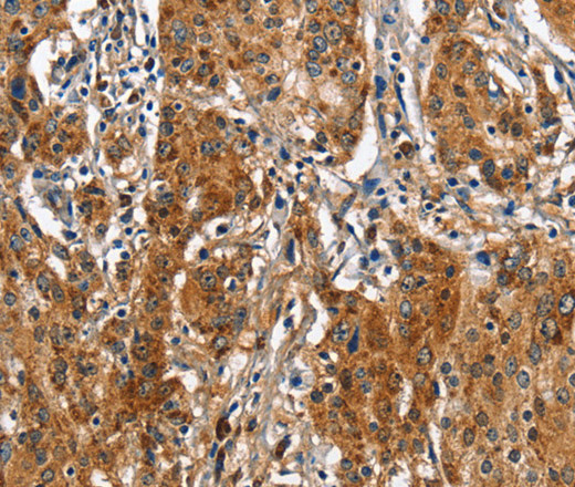 Immunohistochemistry of paraffin-embedded Human gastic cancer using BGN Polyclonal Antibody at dilution of 1:50