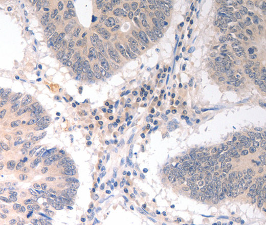 Immunohistochemistry of paraffin-embedded Human colon cancer tissue using CD275 Polyclonal Antibody at dilution 1:30