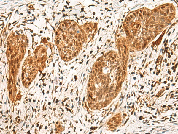 Immunohistochemistry of paraffin-embedded Human esophagus cancer tissue  using POLR1E Polyclonal Antibody at dilution of 1:40(?200)