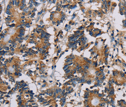 Immunohistochemistry of paraffin-embedded Human colon cancer using MRPL39 Polyclonal Antibody at dilution of 1:30