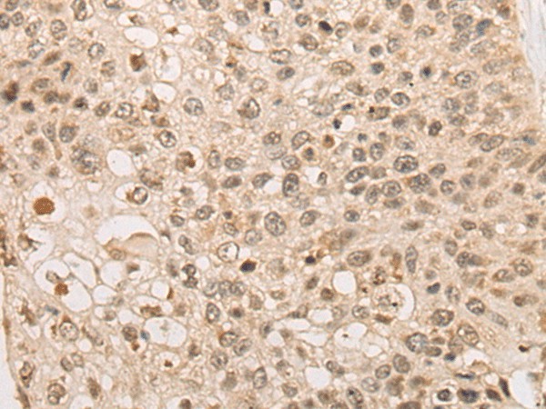 Immunohistochemistry of paraffin-embedded Human lung cancer tissue  using CAPN15 Polyclonal Antibody at dilution of 1:50(?200)