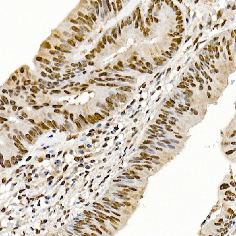 Immunohistochemistry of paraffin-embedded human colon carcinoma using SETMAR Polyclonal Antibody at dilution of 1:100 (40x lens).Perform high pressure antigen retrieval with 10 mM citrate buffer pH 6.0 before commencing with IHC staining protocol.