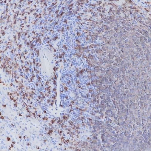 Recombinant CD20 Monoclonal Antibody - 2
