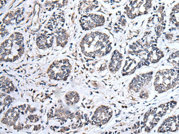 Immunohistochemistry of paraffin-embedded Human esophagus cancer tissue  using UBE2E3 Polyclonal Antibody at dilution of 1:40(?200)