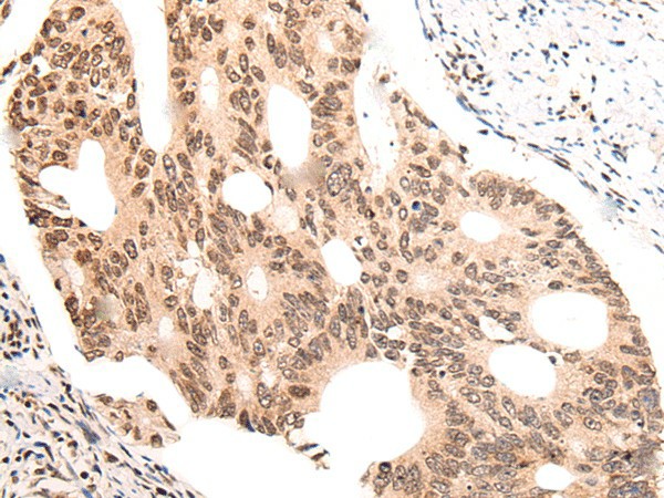 Immunohistochemistry of paraffin-embedded Human colorectal cancer tissue  using KNOP1 Polyclonal Antibody at dilution of 1:55(?200)