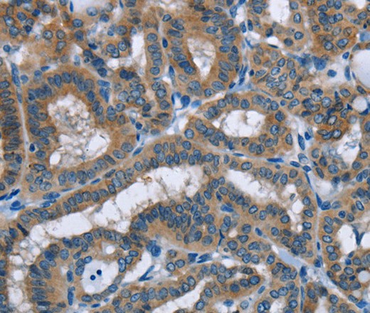 Immunohistochemistry of paraffin-embedded Human thyroid cancer tissue using PLIN1 Polyclonal Antibody at dilution 1:30