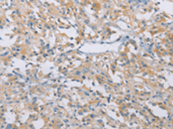 Immunohistochemistry of paraffin-embedded Human thyroid cancer tissue  using CDKN2A Polyclonal Antibody at dilution of 1:50(?200)