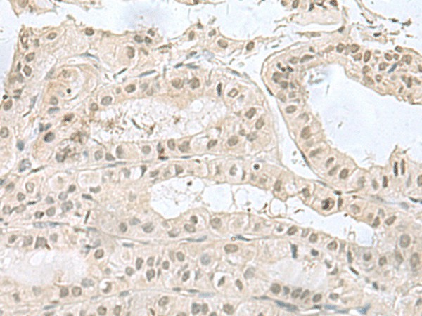 Immunohistochemistry of paraffin-embedded Human thyroid cancer tissue  using PCBD1 Polyclonal Antibody at dilution of 1:60(?200)