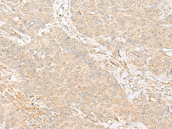 Immunohistochemistry of paraffin-embedded Human ovarian cancer tissue  using TRAF6 Polyclonal Antibody at dilution of 1:30(?200)