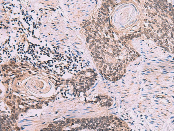 Immunohistochemistry of paraffin-embedded Human esophagus cancer tissue  using CDK4 Polyclonal Antibody at dilution of 1:60(?200)