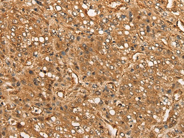 Immunohistochemistry of paraffin-embedded Human liver cancer tissue  using CALML6 Polyclonal Antibody at dilution of 1:55(?200)