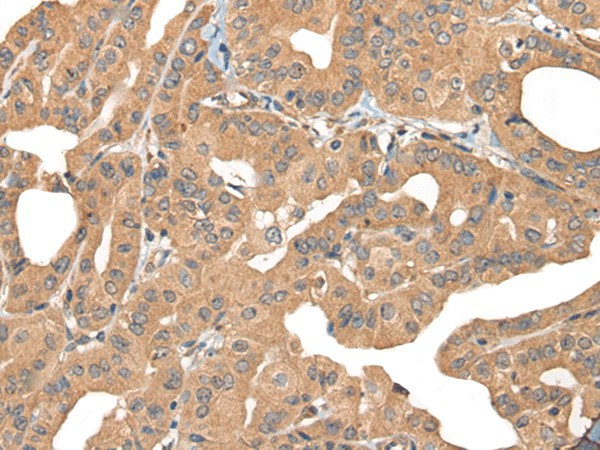 Immunohistochemistry of paraffin-embedded Human thyroid cancer tissue  using PPP3R1 Polyclonal Antibody at dilution of 1:55(?200)