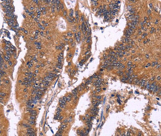 Immunohistochemistry of paraffin-embedded Human colon cancer using SEPT7 Polyclonal Antibody at dilution of 1:50