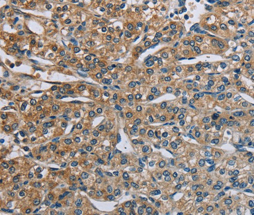 Immunohistochemistry of paraffin-embedded Human prostate cancer using PLXND1 Polyclonal Antibody at dilution of 1:40