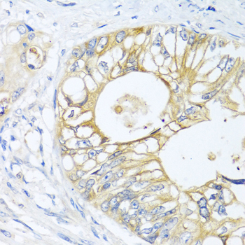 Immunohistochemistry of paraffin-embedded Human colon carcinoma using GNAI3 Polyclonal Antibody at dilution of 1:100 (40x lens).