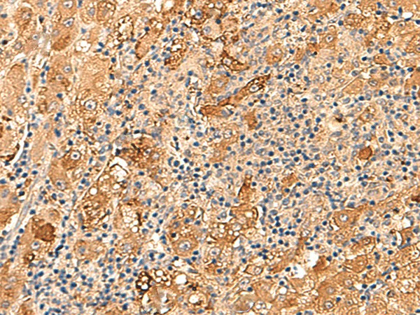 Immunohistochemistry of paraffin-embedded Human liver cancer tissue  using KCNE3 Polyclonal Antibody at dilution of 1:60(?200)