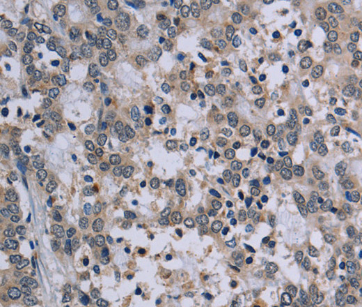 Immunohistochemistry of paraffin-embedded Human liver cancer tissue using TP53AIP1 Polyclonal Antibody at dilution 1:50