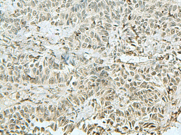 Immunohistochemistry of paraffin-embedded Human ovarian cancer tissue  using THTPA Polyclonal Antibody at dilution of 1:90(?200)