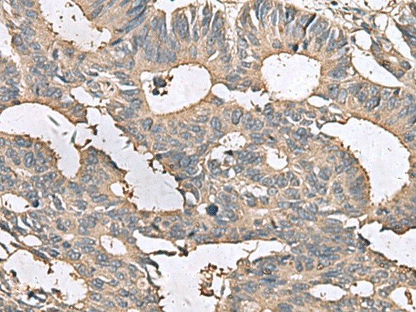 Immunohistochemistry of paraffin-embedded Human colorectal cancer tissue  using MRPL42 Polyclonal Antibody at dilution of 1:65(?200)