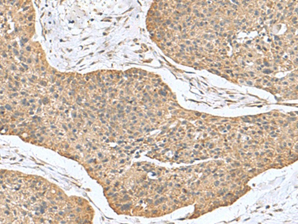 Immunohistochemistry of paraffin-embedded Human esophagus cancer tissue  using CSRP2 Polyclonal Antibody at dilution of 1:70(?200)