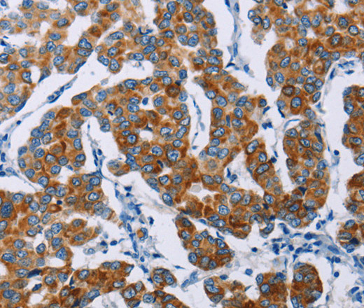 Immunohistochemistry of paraffin-embedded Human breast cancer tissue using NCR3 Polyclonal Antibody at dilution 1:40