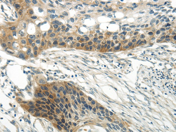 Immunohistochemistry of paraffin-embedded Human esophagus cancer tissue using WNT6 Polyclonal Antibody at dilution 1:35