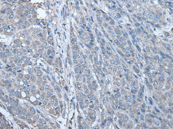 Immunohistochemistry of paraffin-embedded Human liver cancer tissue  using ZC3HAV1 Polyclonal Antibody at dilution of 1:70(?200)