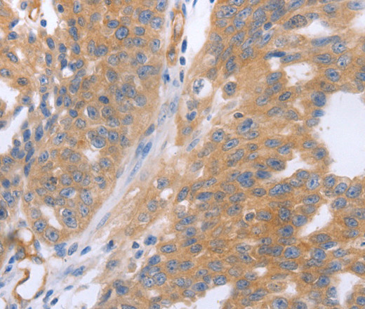 Immunohistochemistry of paraffin-embedded Human breast cancer tissue using NRTN Polyclonal Antibody at dilution 1:60