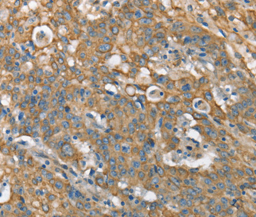 Immunohistochemistry of paraffin-embedded Human gastric cancer tissue using CSMD1 Polyclonal Antibody at dilution 1:40