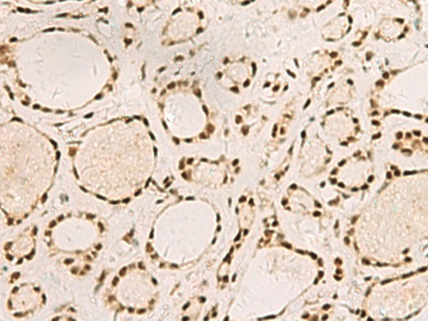 Immunohistochemistry of paraffin-embedded Human thyroid cancer tissue  using SAP30BP Polyclonal Antibody at dilution of 1:45(?200)