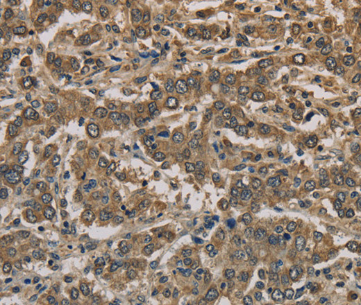 Immunohistochemistry of paraffin-embedded Human liver cancer using CK-16 Polyclonal Antibody at dilution of 1:30