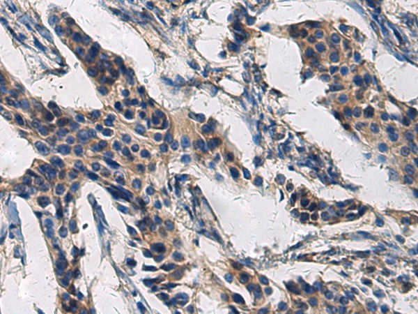 Immunohistochemistry of paraffin-embedded Human breast cancer tissue  using COL17A1 Polyclonal Antibody at dilution of 1:50(?200)