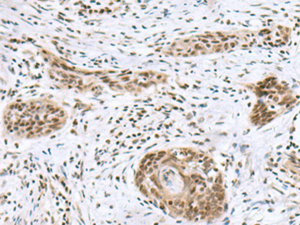 Immunohistochemistry of paraffin-embedded Human esophagus cancer tissue  using INSM1 Polyclonal Antibody at dilution of 1:50(?200)