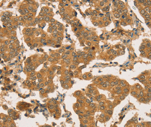 Immunohistochemistry of paraffin-embedded Human breast cancer tissue using RBBP8 Polyclonal Antibody at dilution 1:45