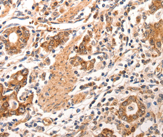 Immunohistochemistry of paraffin-embedded Human gastric cancer using CCL17 Polyclonal Antibody at dilution of 1:70