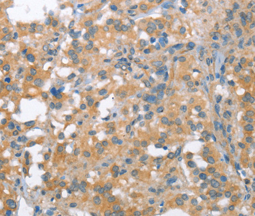 Immunohistochemistry of paraffin-embedded Human thyroid cancer tissue using NLRP7 Polyclonal Antibody at dilution 1:40