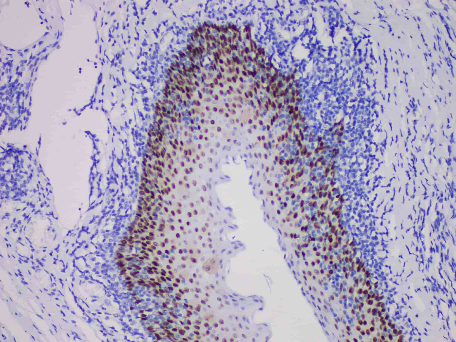 Immunohistochemistry of paraffinembedded Human esophageal squamous cell carcinoma with SOX-2 Monoclonal Antibody(Antigen repaired by EDTA).