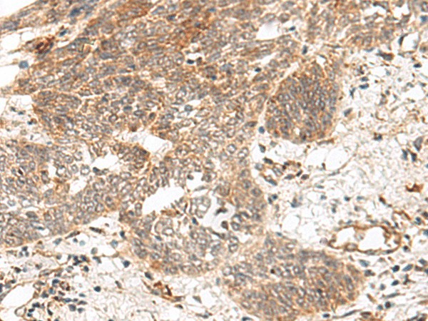 Immunohistochemistry of paraffin-embedded Human esophagus cancer tissue  using GRASP Polyclonal Antibody at dilution of 1:150(?200)