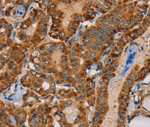 Immunohistochemistry of paraffin-embedded Human thyroid cancer tissue using MBNL3 Polyclonal Antibody at dilution 1:30