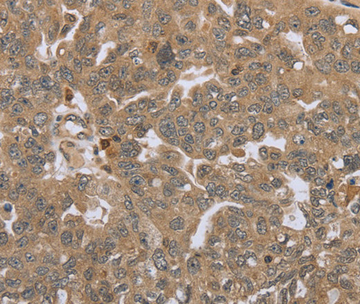 Immunohistochemistry of paraffin-embedded Human ovarian cancer tissue using STMN2/3/4 Polyclonal Antibody at dilution 1:45