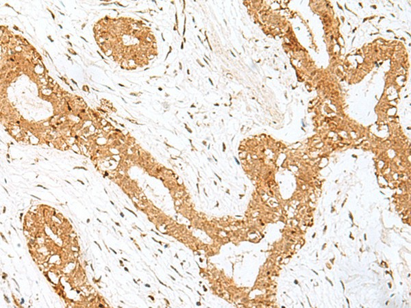 Immunohistochemistry of paraffin-embedded Human breast cancer tissue  using GOLGA7 Polyclonal Antibody at dilution of 1:40(?200)