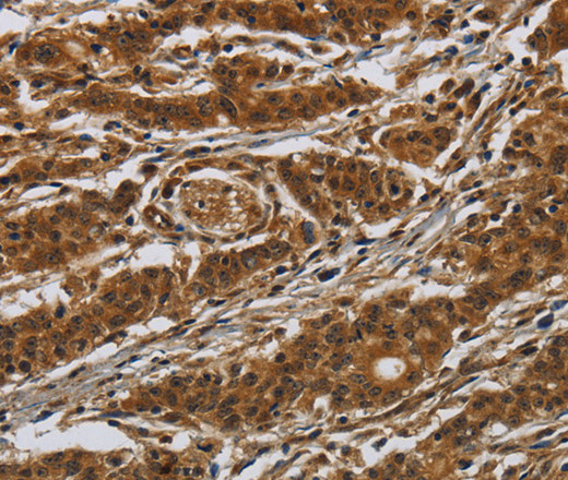 Immunohistochemistry of paraffin-embedded Human gasrtic cancer tissue using GATA5 Polyclonal Antibody at dilution 1:50