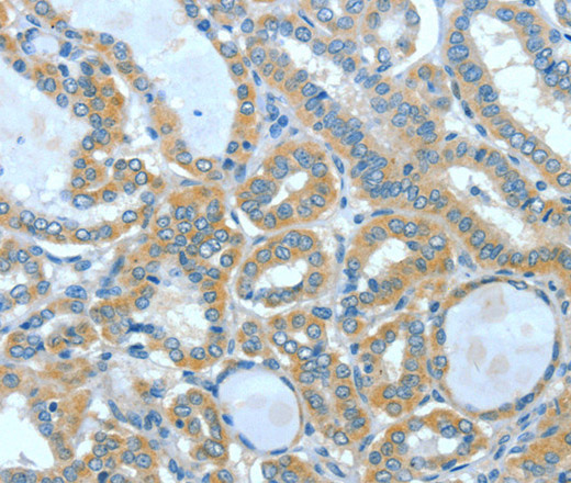 Immunohistochemistry of paraffin-embedded Human thyroid cancer using SPHK2 Polyclonal Antibody at dilution of 1:60