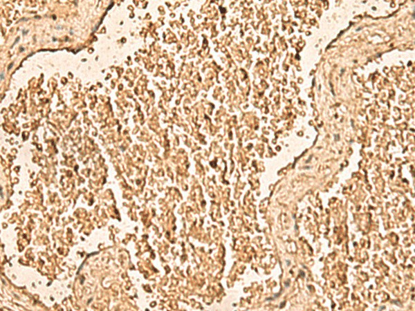 Immunohistochemistry of paraffin-embedded Human gastric cancer tissue  using WDR33 Polyclonal Antibody at dilution of 1:50(?200)